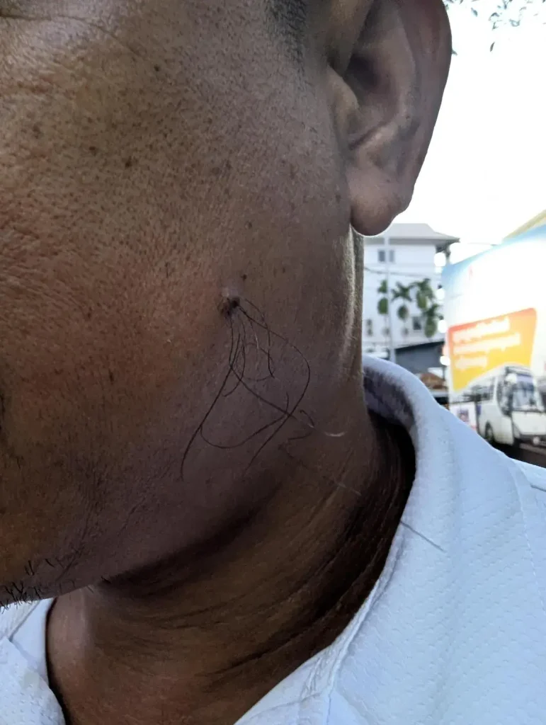 Six hairs of about two and a half inches in length growing through a mole on a person's face. As this person is from Southeast Asia, they consider this (a hair growing through a mole) to be lucky, and will not cut or pluck the hair. They will allow it to continue to grow. They have no other facial hair other than this.